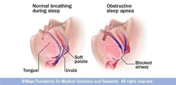 Sleep Apnea